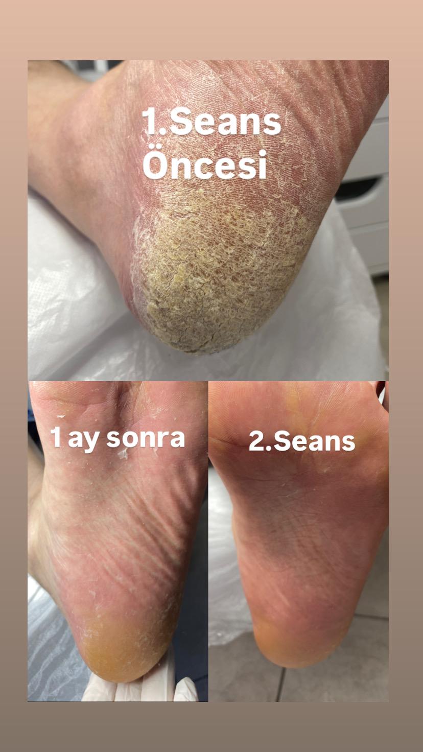 ÇATLAK TOPUK BAKIMI